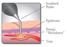 Spider vein removal deals nyc