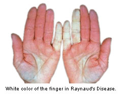 What are the symptoms of Raynaud's syndrome?