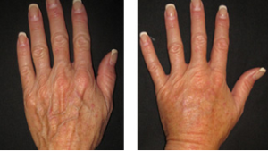 Hand Veins - Top Varicose Vein Treatment NYC