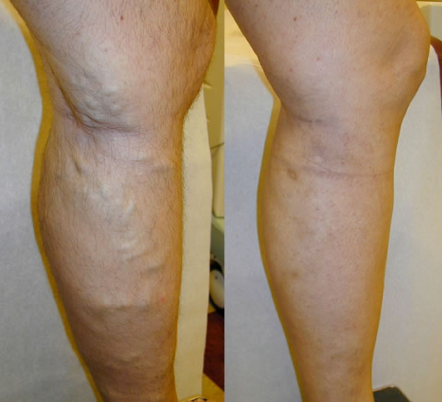 Endovenous Laser Ablation - Top Varicose Vein Treatment NYC