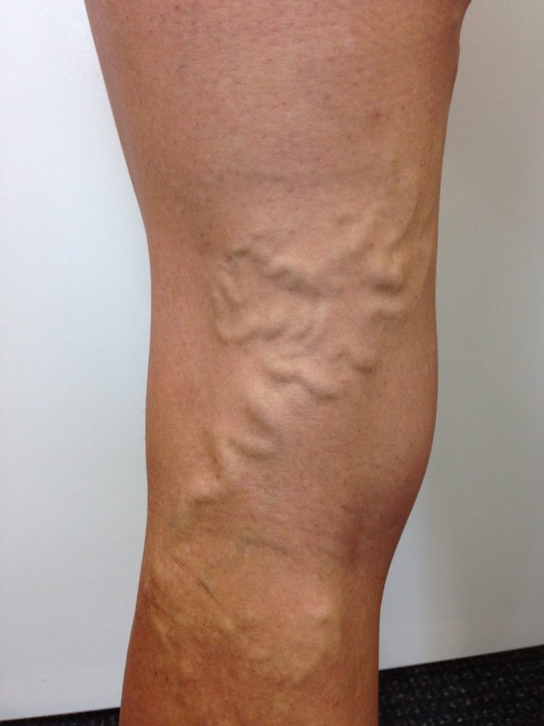 ugly-leg-veins-treatments-causes-vein-clinic-perth