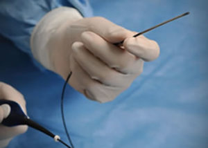 What is Catheter Ablation for Varicose Veins?