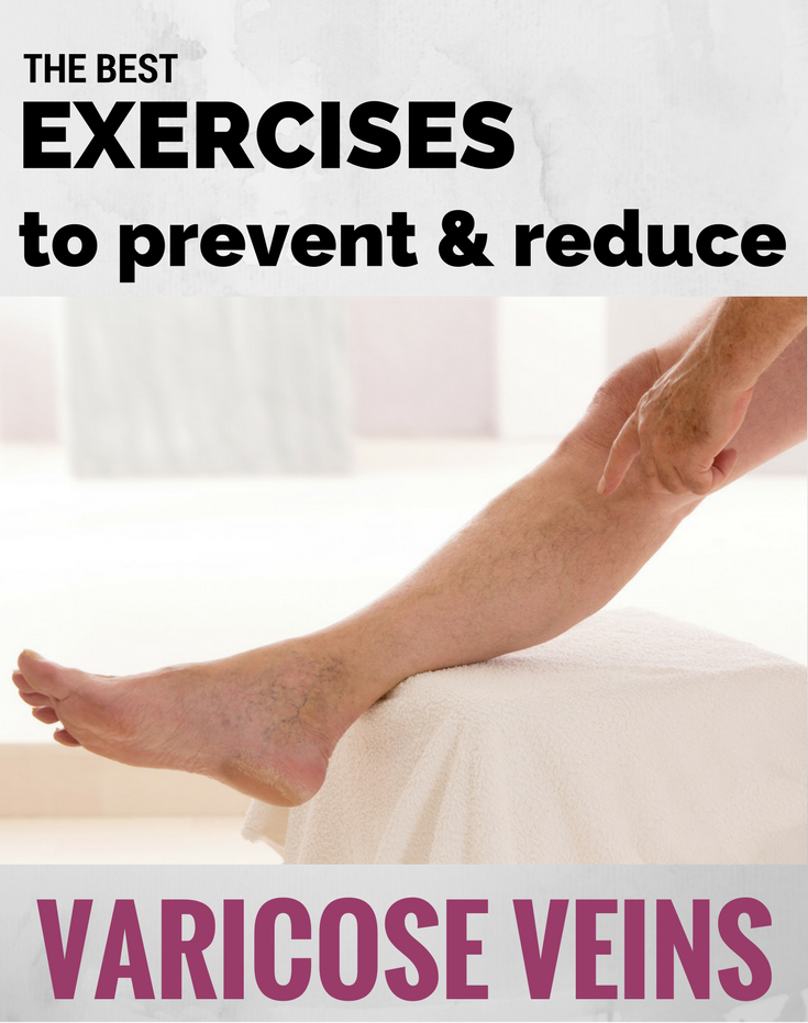Exercises for varicose veins in feet - Vena de perete varicose wall