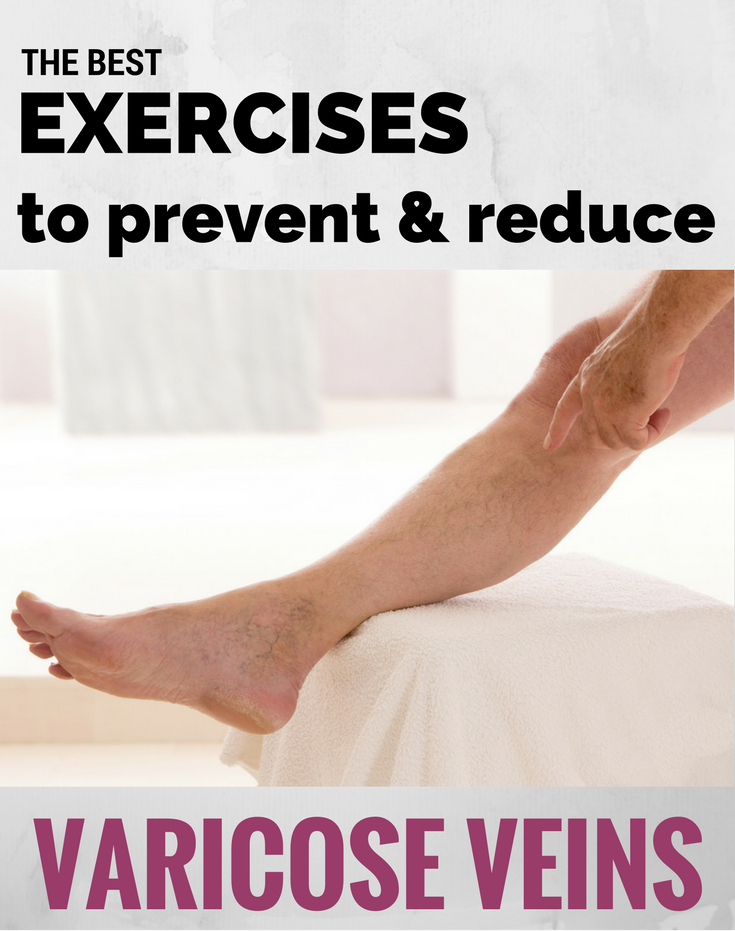 The Best Exercises for Varicose Veins - Top Varicose Vein