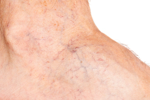 Causes Of Spider Veins & Treatment Options - Top Varicose Vein