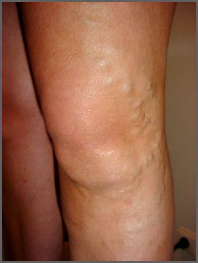 Prevent Varicose Veins- Tips and Lifestyle Changes