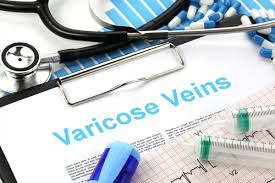 Endovenous Laser Treatment EVLT for varicose veins NYC best